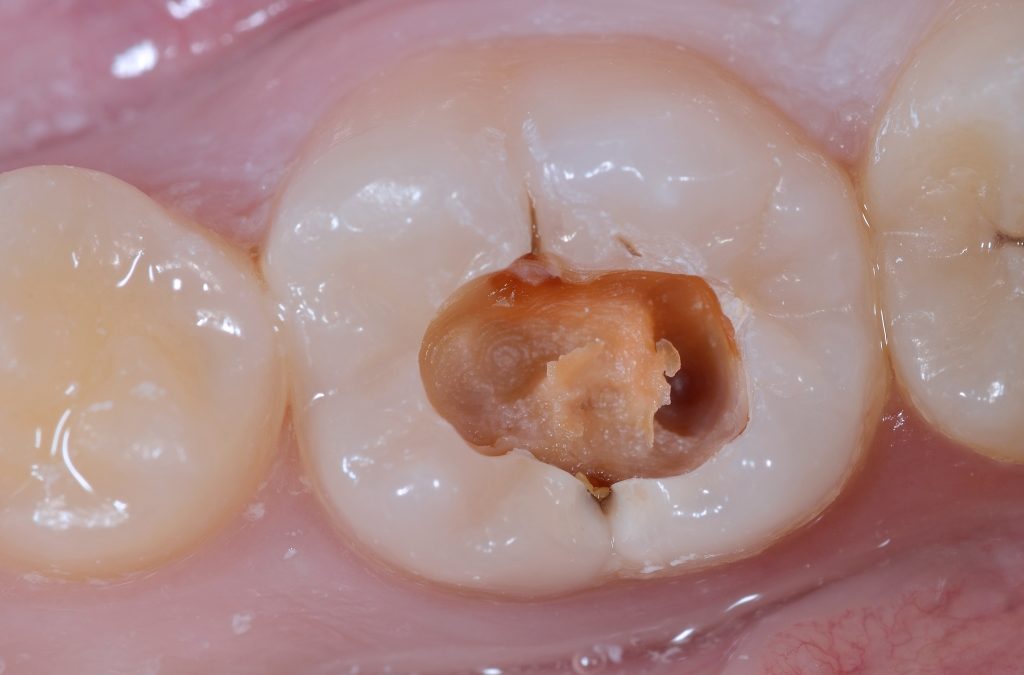 la CARIE, cos’è? AIC ce lo spiega (argomento n.5)
