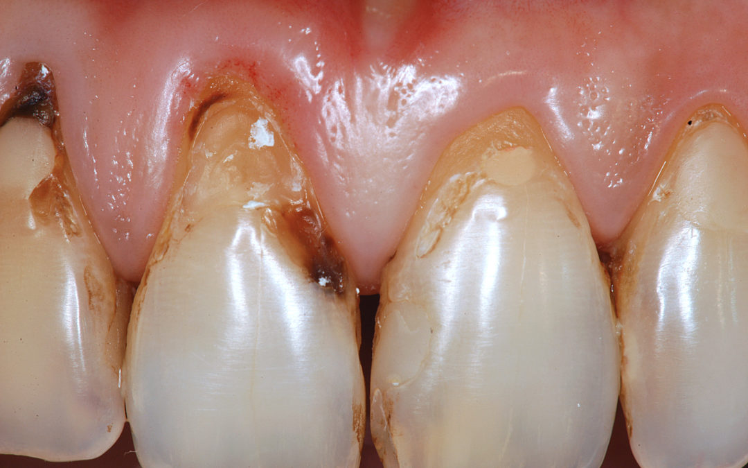 Cosa sono le lesioni non cariose dei denti? (argomento n.7)