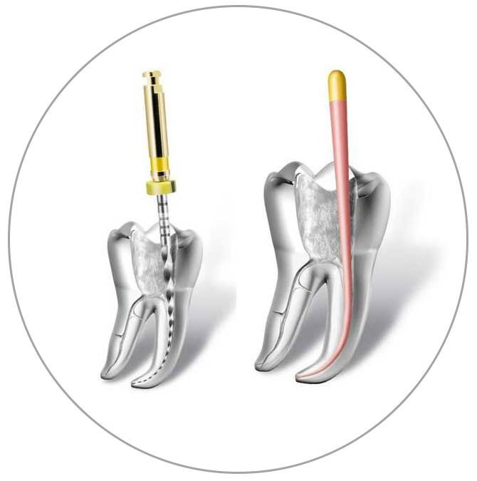 La devitalizzazione, cos’è? (art. 8)