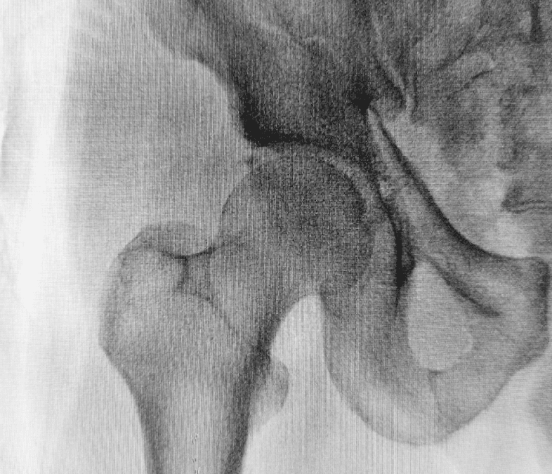 Calcola il tuo “Rischio Osteoporosi”