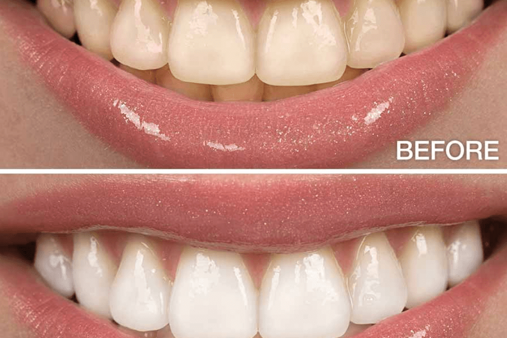 Quanto dura l’effetto dello Sbiancamento dei Denti?