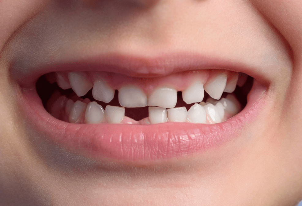 Anche i denti sono soggetti a traumi.