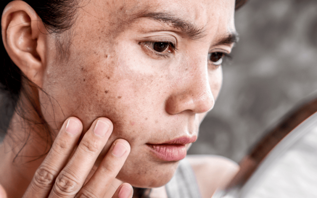 โ๏ธ Macchie solari e pelle sensibile: cosa fare prima dellโestate?